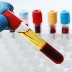 Czym jest osocze bogatopłytkowe? Wskazania do zabiegu